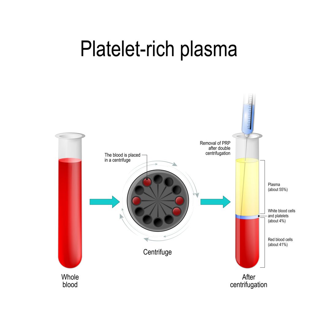 Platelet-rich plasma. 